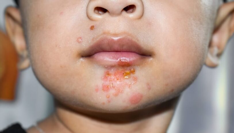 Impetigo