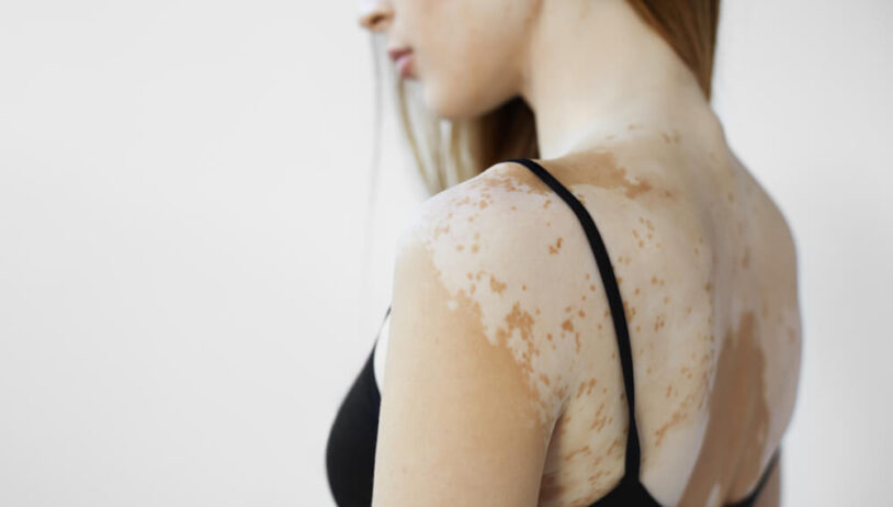 Vitiligo