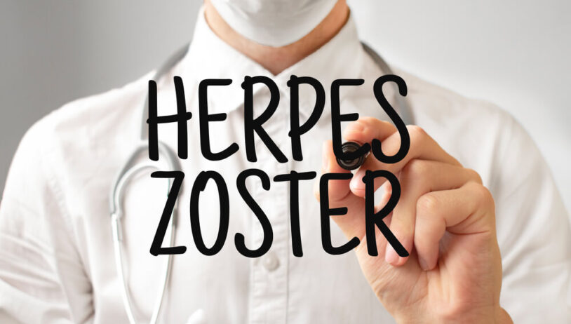 Herpes zoster